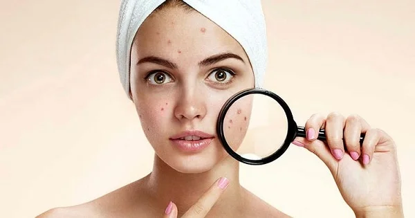 Top 7+ spa trị mụn Đà Nẵng - Điều trị tận gốc uy tín nhất 9 Spa trị mụn Đà Nẵng