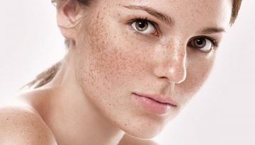 Spa trị nám tại Đà Nẵng